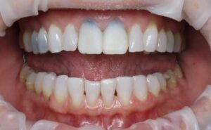  Dark stain appeared under provisional restorations after 2 weeks. 