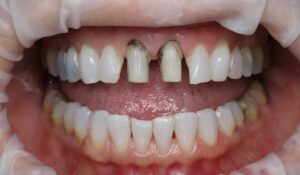  Dark stain present on teeth after removing provisional restorations. 
