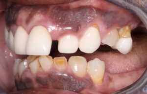 Left lateral view showing multiple aesthetics and functional deficits