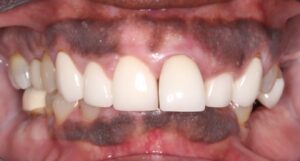 Frontal view in maximum intercuspation. 