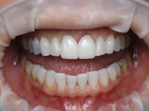  Dark stain removed with hydrogen peroxide and permanent crowns cemented.