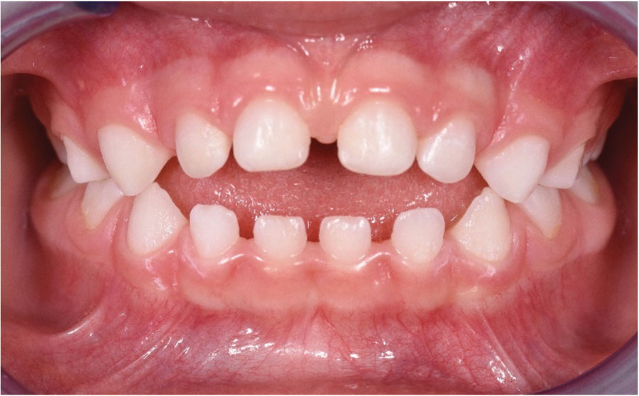 Initial photo showing the consequences of using a pacifier in a child three years old, open bite associated with an anterior crossbite tendency, as well as a lower posture of the tongue at rest