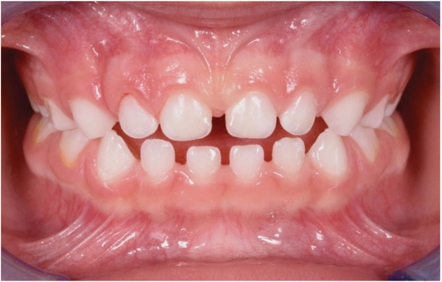  Patient’s photo showing the correction after using the Pediatric Bio-Activator DC for 6 months; 