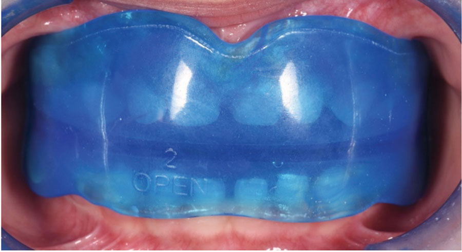 . Patient wearing the second appliance, BioActivator-OPEN, to finalize closing the open bite. The patient used this appliance for 18 months