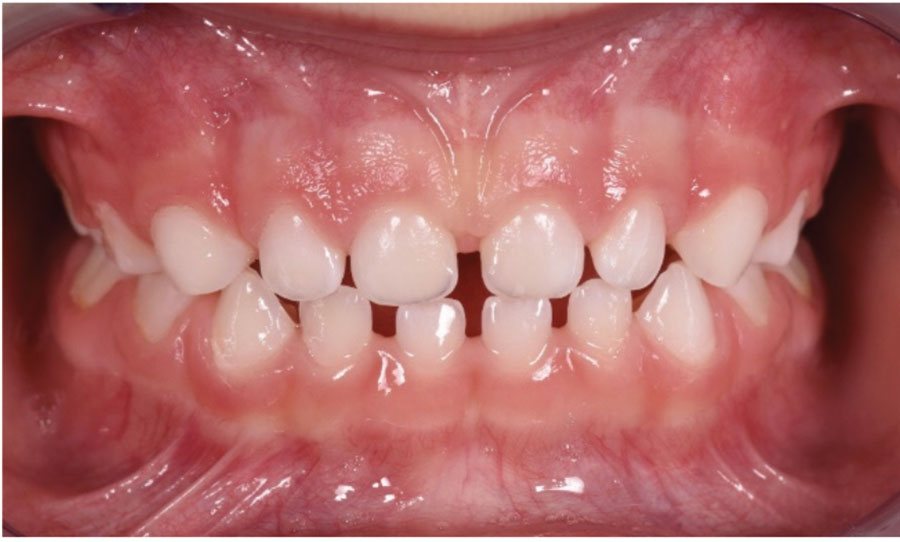 . Patient’s photo showing the final results after the treatment with the BioActivator appliances. The structural and functional problems were corrected at an early age in primary dentition.