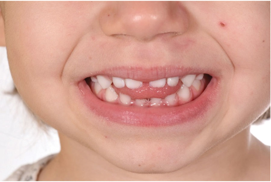 . Patient’s photos comparing the before and after treatment. Obsever the tongue between the incisors, tongue thrust, before the treatment and, after the malocclusion corrected with no tongue thrust.