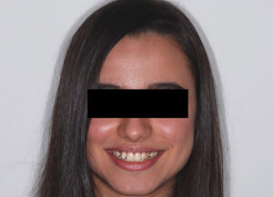  Full face front view (before).  