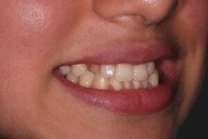  Right side view ,teeth in occlusion ( before).  