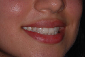  Right side view, teeth in occlusion (after).  