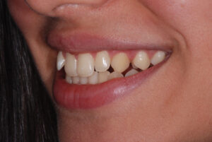 Left side view ,teeth apart ( before). 