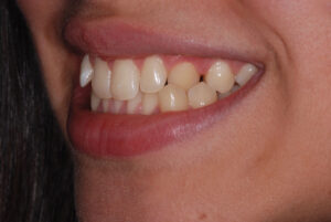 . Left side view ,teeth in occlusion ( before). 