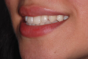  Left side view, teeth in occlusion (after). 
