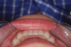  Lower arch occlusal view (after). 
