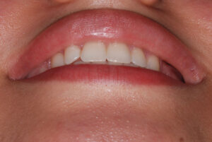 Front chin-up view (after.   
