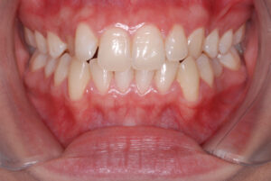  Front close up view, teeth apart and cheeks retracted (before). 