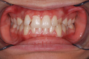 Front close up view, teeth in occlusion and cheeks retracted (before).
