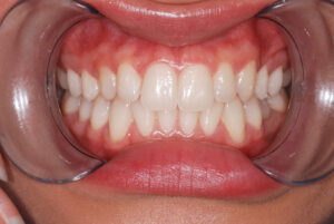 . Front close up view, teeth in occlusion and cheeks retracted (after).  