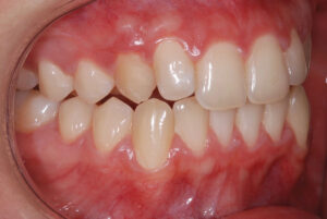Right close up view, teeth apart and cheeks retracted(before).  