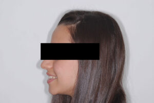 Full face profile view (before). 