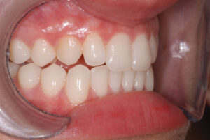 Right close up view, teeth apart and cheeks retracted (after).  