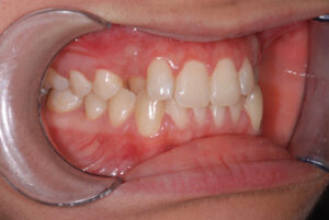 Right close up view, teeth in occlusion and cheeks retracted(before).  
