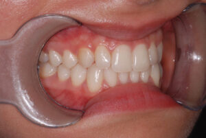  Right close up view, teeth in occlusion and cheeks retracted (after).