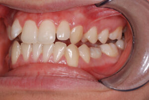 Left close up view, teeth apart and cheeks retracted(before).