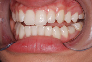  Left close up view, teeth apart and cheeks retracted (after)