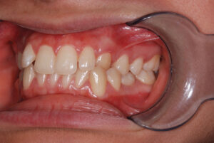 Left close up view, teeth in occlusion and cheeks retracted(before).  