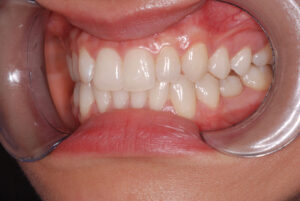 Left close up view, teeth in occlusion and cheeks retracted (after).