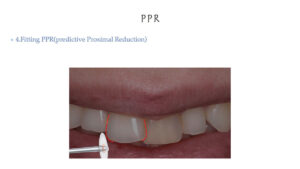 PPR using disc.