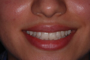  Front close up smile view, teeth in occlusion (after).  