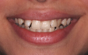 . Front close up smile view, teeth apart (before). 