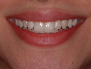 Front close up smile view, teeth apart (after). 