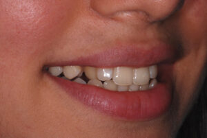 Right side view ,teeth apart ( before).