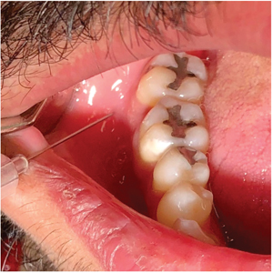 Intraoral cervical plexus injection.  