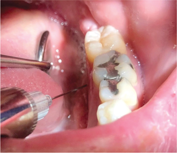 Lingual infiltration of mylohyoid branches. 