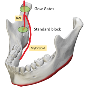 Gow Gates versus standard block injection.18