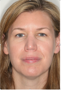 Patient A: 2008 before any treatment.  